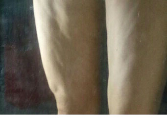 女子抽脂后腿部凹凸不平 健康减肥才是王道,你说呢?