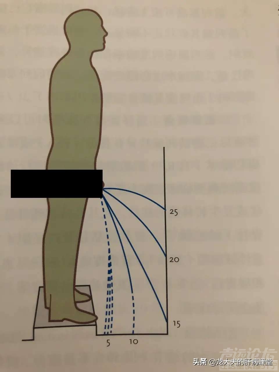 男性排尿流速目测法,自我评估你的前列腺